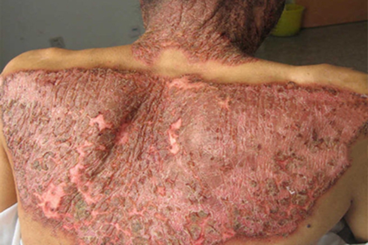 烟酸缺乏症背部症状图