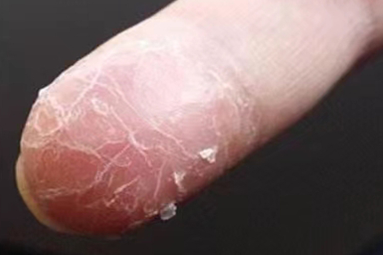 鳞屑角化型手癣脱皮图 鳞屑角化型手癣脱皮图