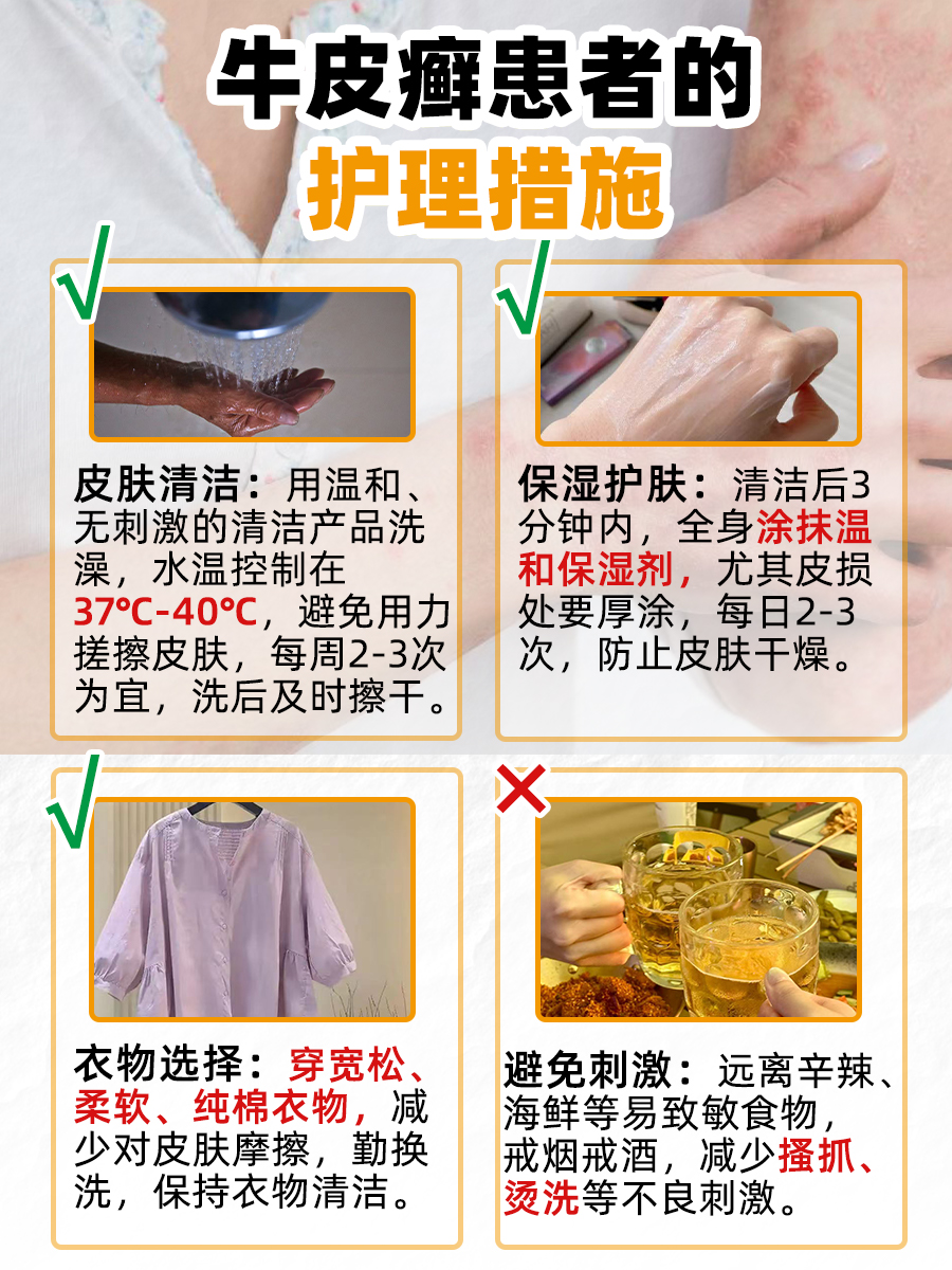 牛皮癣治疗得花多少钱？答案在这！
