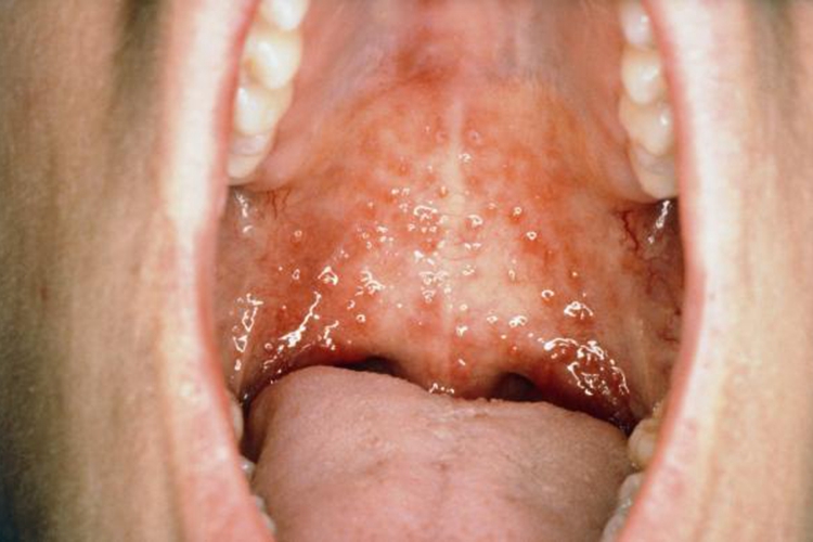 原发性疱疹性口炎图 原发性疱疹性口炎图