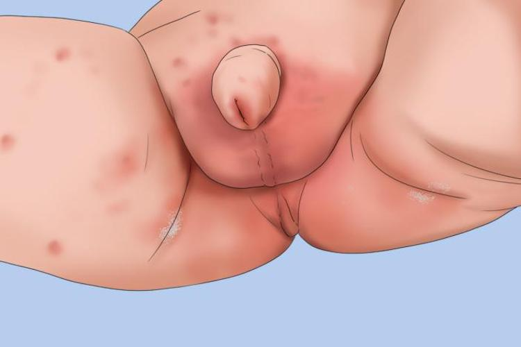 尿布皮炎图 尿布皮炎图