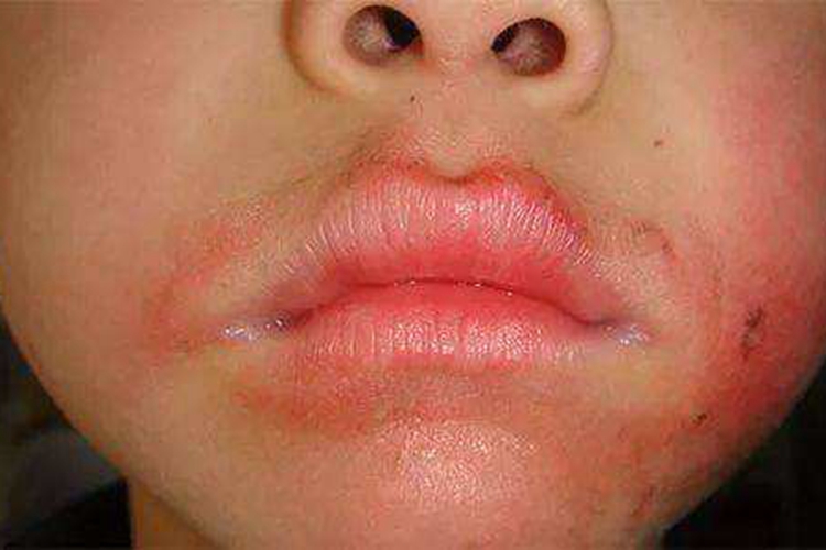孩子口角接触性皮炎图