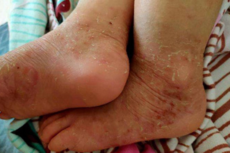 渗出型婴儿湿疹双脚发红脱皮图