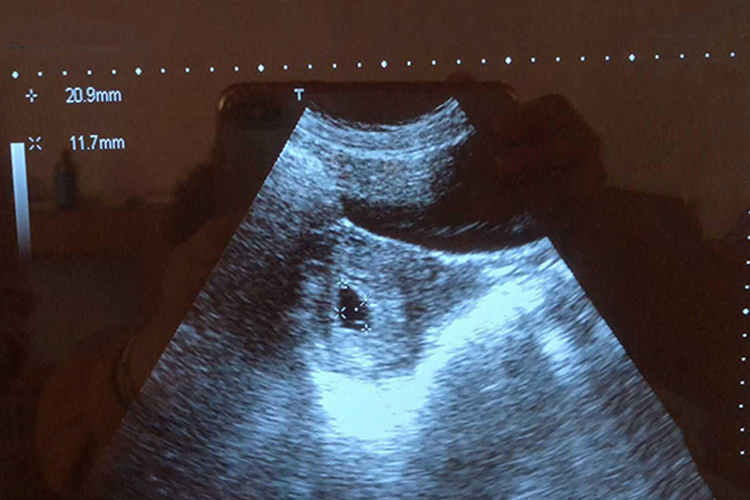 怀孕32天孕囊B超图