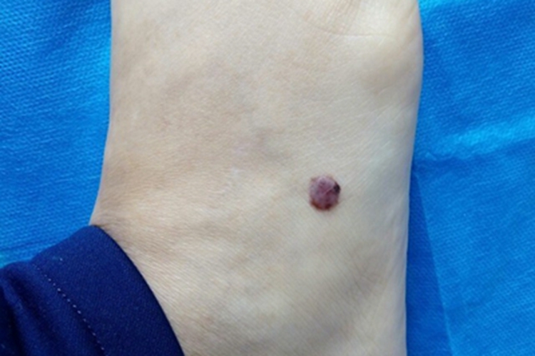 复合痣脚背症状图 复合痣脚背症状图