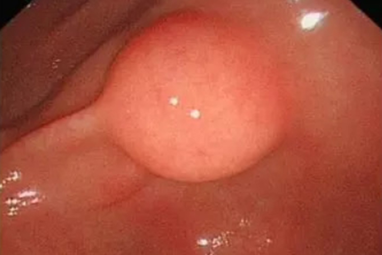 胃外壁脂肪瘤图