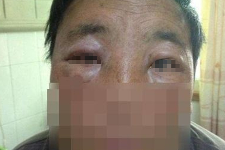 炭疽病眼周水肿图