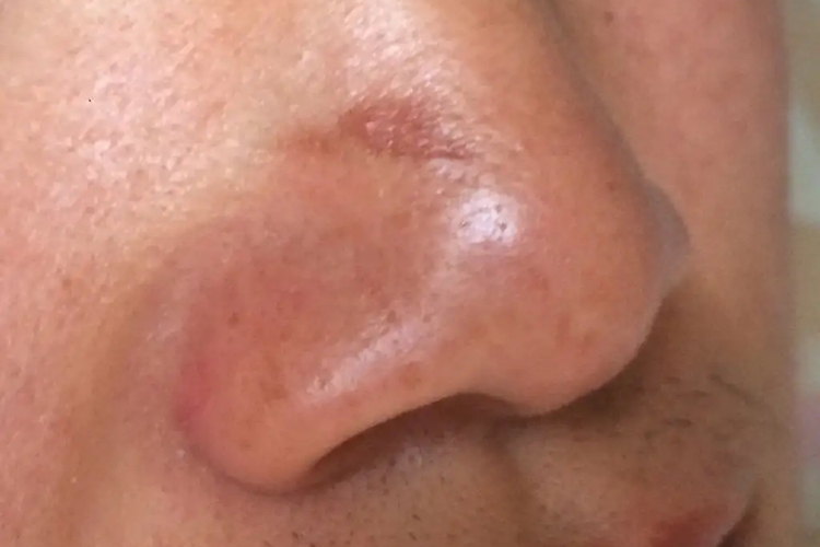 鼻子上炎症后色素沉着图