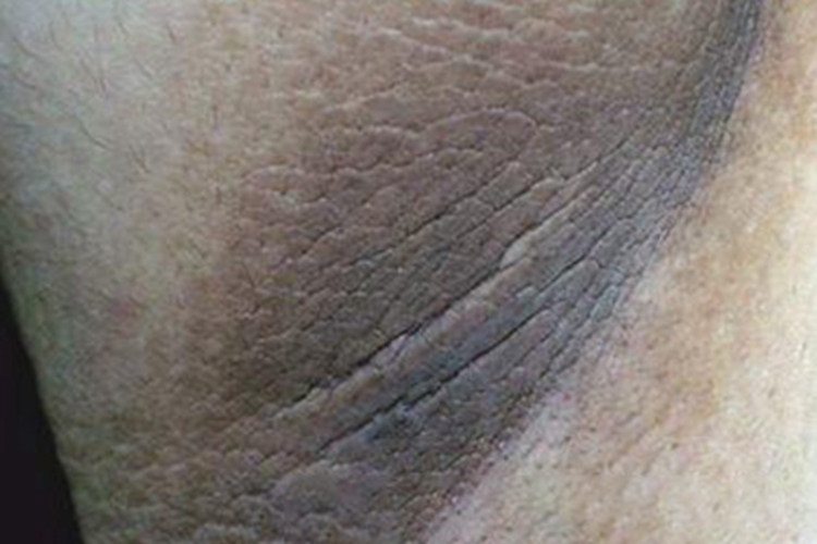 假性黑棘皮病腋窝皮肤增厚图 假性黑棘皮病腋窝皮肤增厚图