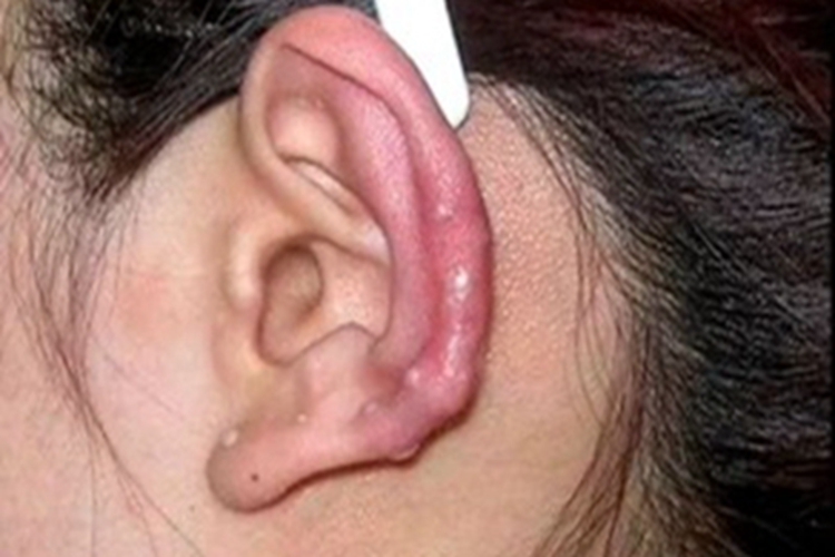 耳廓化脓性软骨膜炎耳廓红肿图 耳廓化脓性软骨膜炎耳廓红肿图