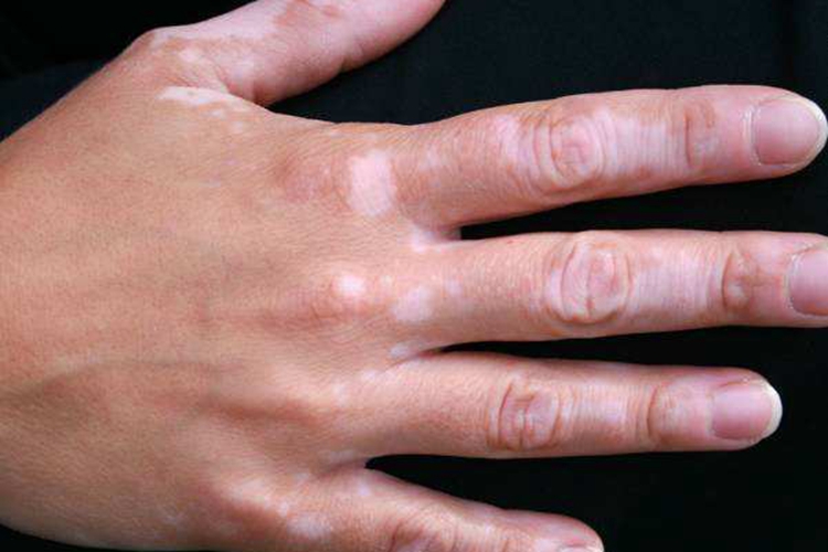 手部无色素痣白斑图