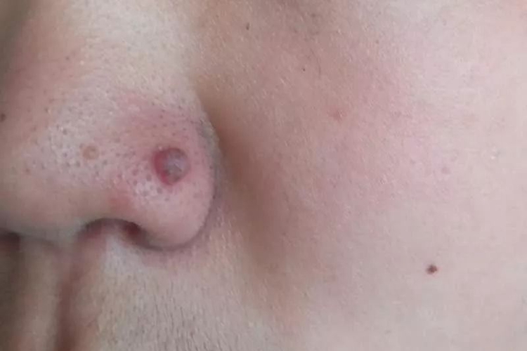 鼻翼寻常疣图 鼻翼寻常疣图