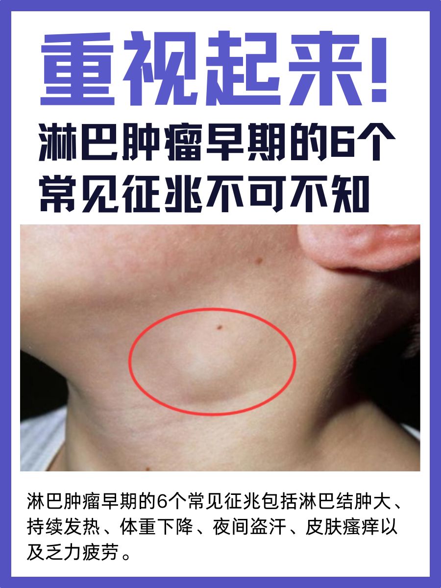重视起来！淋巴肿瘤早期的6个常见征兆不可不知