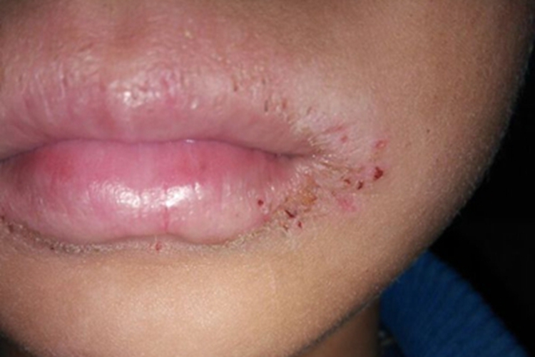 接触性唇炎口周症状图