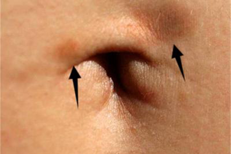穿透型环状肉芽肿肚脐症状图 穿透型环状肉芽肿肚脐症状图