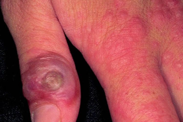 羊痘结节图 羊痘结节图