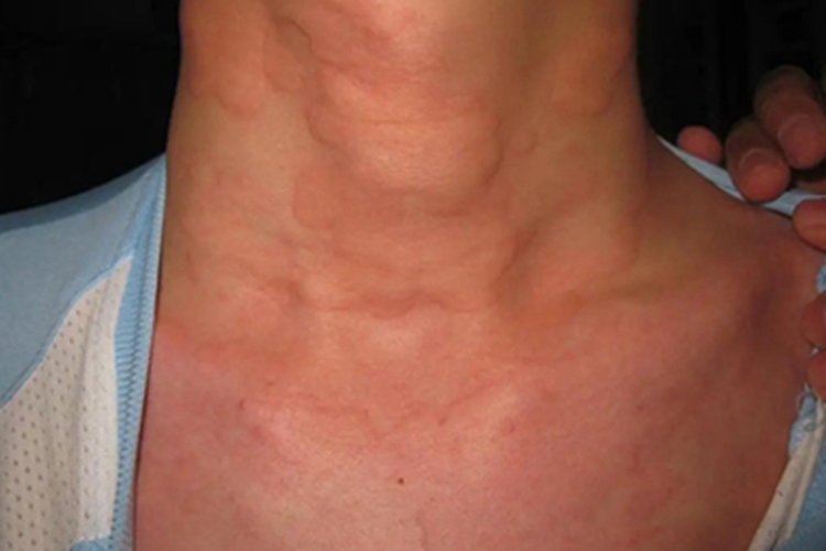 荨麻疹型药疹前颈症状图