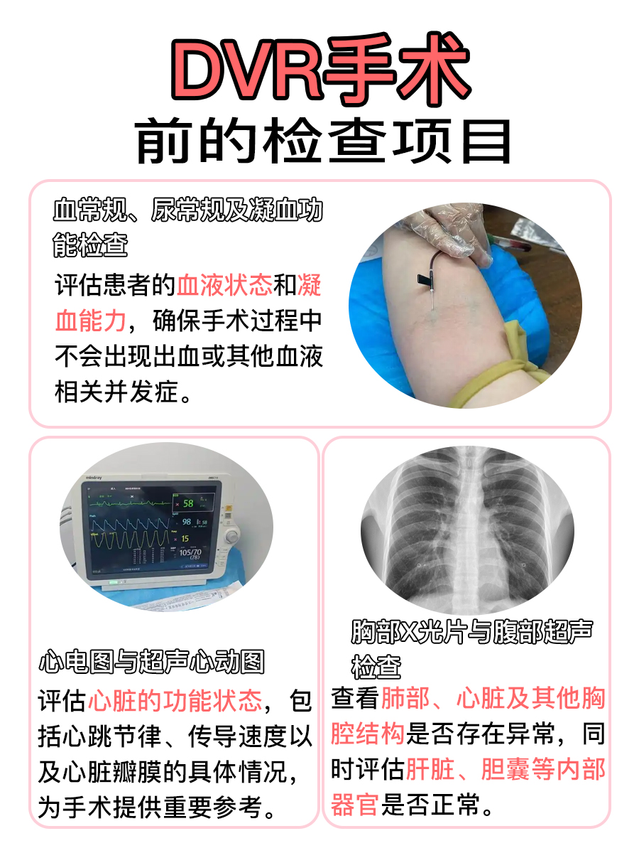 医学前沿:DVR手术全解析