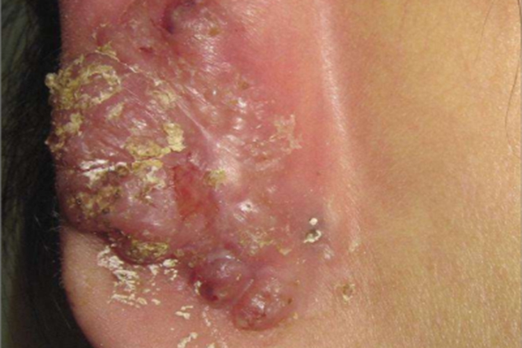 瘰疬性皮肤结核耳廓结节图 瘰疬性皮肤结核耳廓结节图