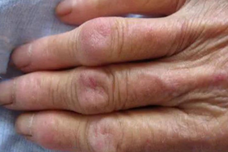 皮肌炎手背症状图