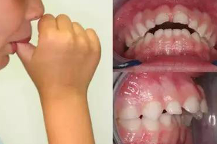 牙列不整上下前牙不能接触图