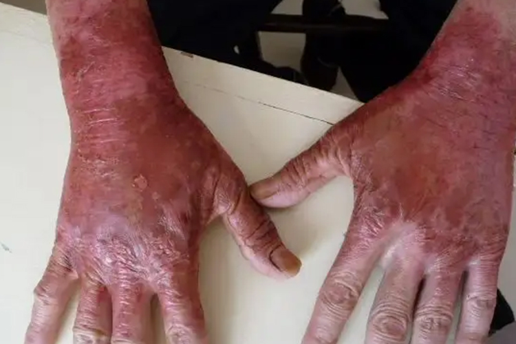 双手对称性焦痂样皮损图