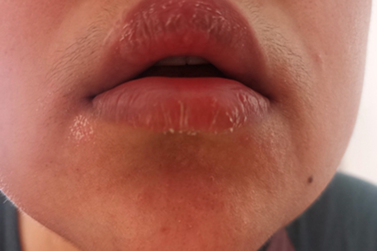 唇炎症状图