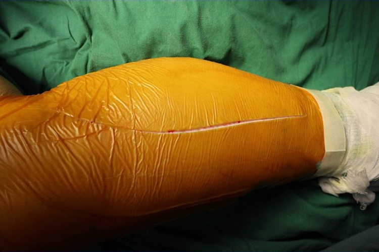 胫骨骨软骨瘤图