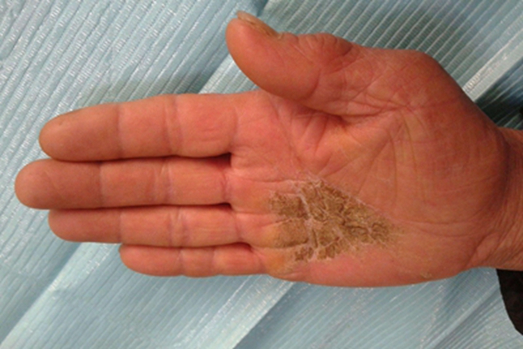 进行性掌跖角化病手掌斑块图 进行性掌跖角化病手掌斑块图