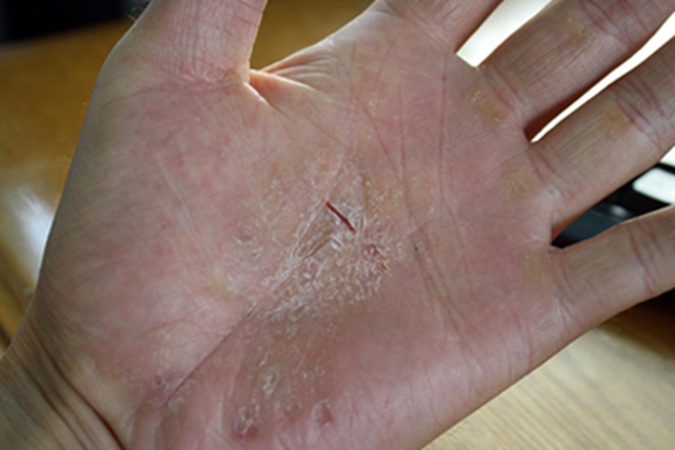 Ⅱ度皮肤皲裂症状图