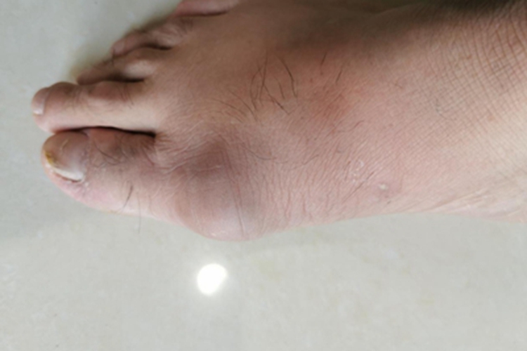 痛风性关节炎脚趾关节鼓大包图 痛风性关节炎脚趾关节鼓大包图