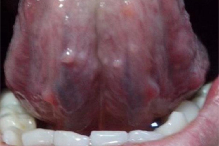 口腔尖锐湿疣舌头小疙瘩图 口腔尖锐湿疣舌头小疙瘩图