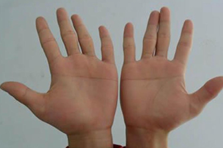 唐氏综合征通贯手图