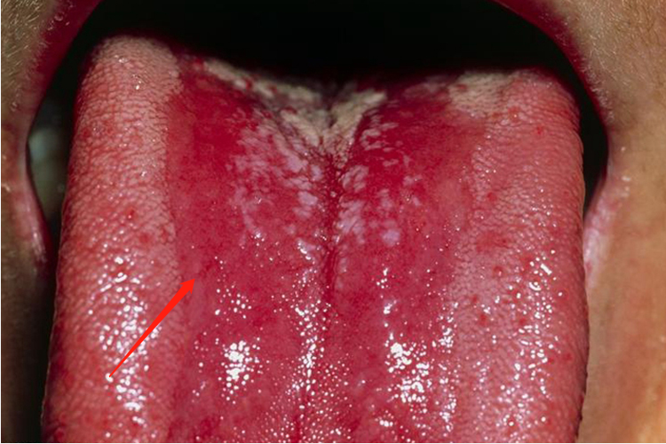 鹅口疮白色变红像出血图