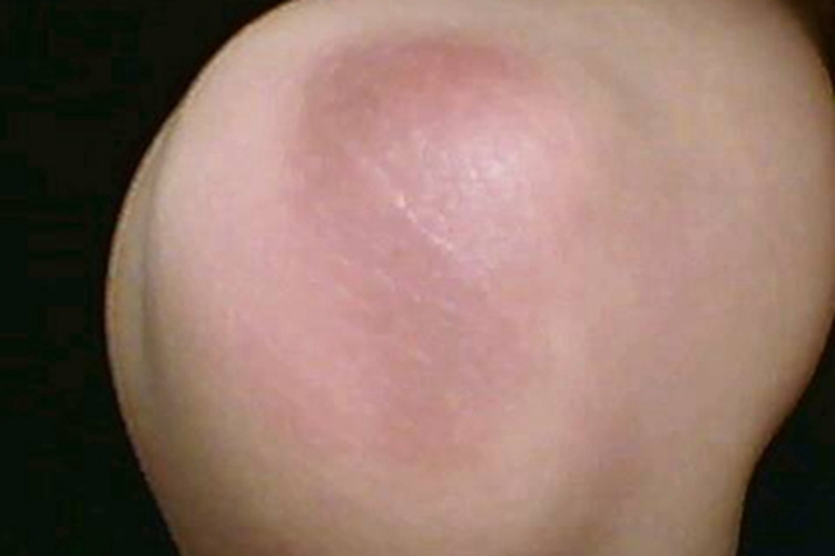 硬红斑肘部症状图