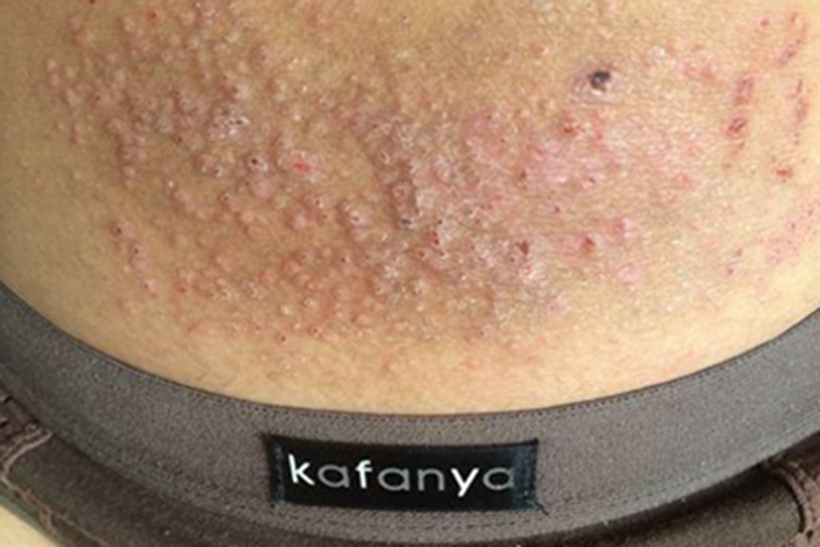 亚急性湿疹腹部红斑小疙瘩图