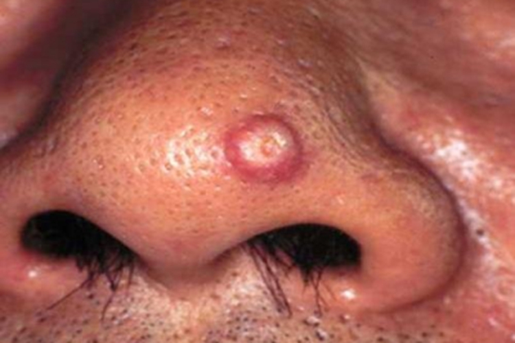 疣状角化不良瘤鼻部症状图 疣状角化不良瘤鼻部症状图