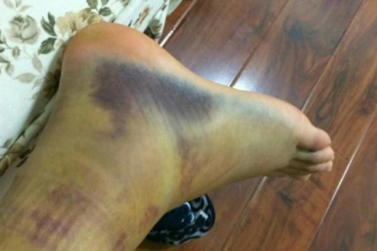 左腓骨外踝骨折脚瘀血图