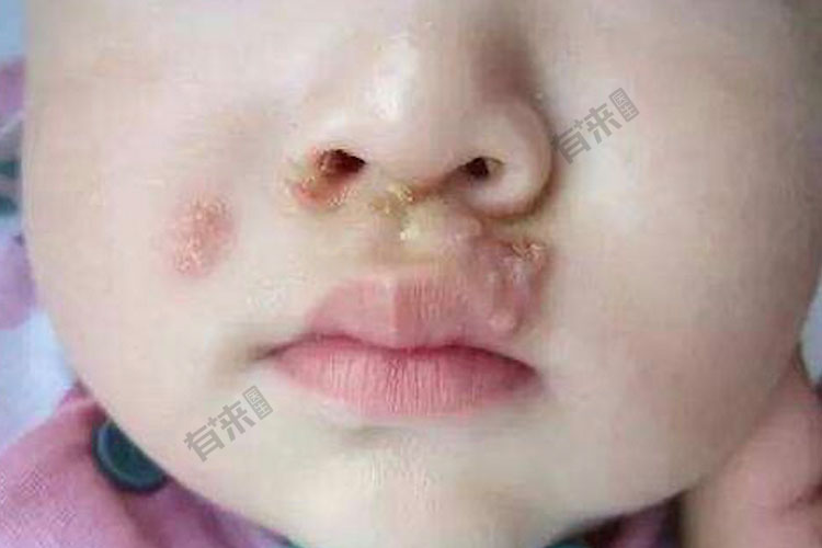 新生儿单纯疱疹图