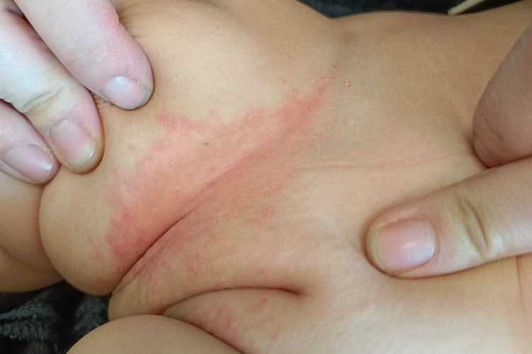 腹股沟部位间擦疹典型皮损图 腹股沟部位间擦疹典型皮损图