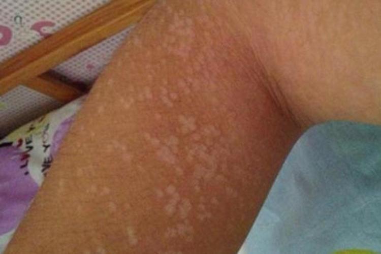 手臂白色糠疹图 手臂白色糠疹图