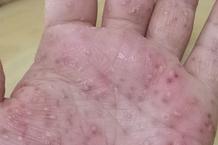 持久性脓疱性汗疱疹手掌起脓包图
