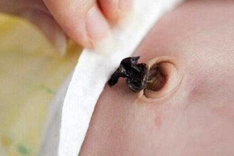 脐带呈黑色条索图