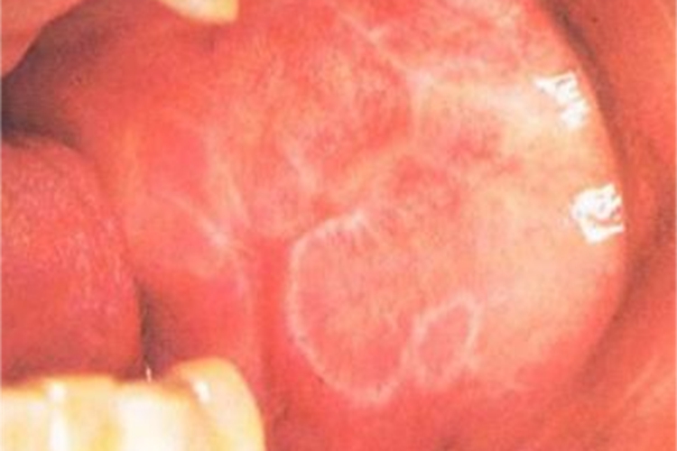 网状型口腔扁平苔藓纹图