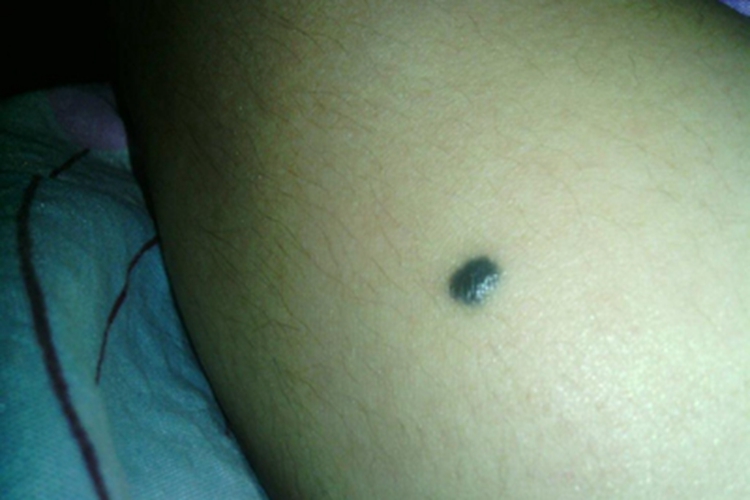 蓝色橡皮疱样痣大腿痣图 蓝色橡皮疱样痣大腿痣图