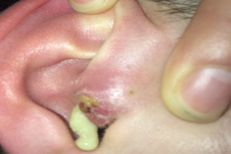 弥漫性外耳道炎外耳道化脓图 弥漫性外耳道炎外耳道化脓图