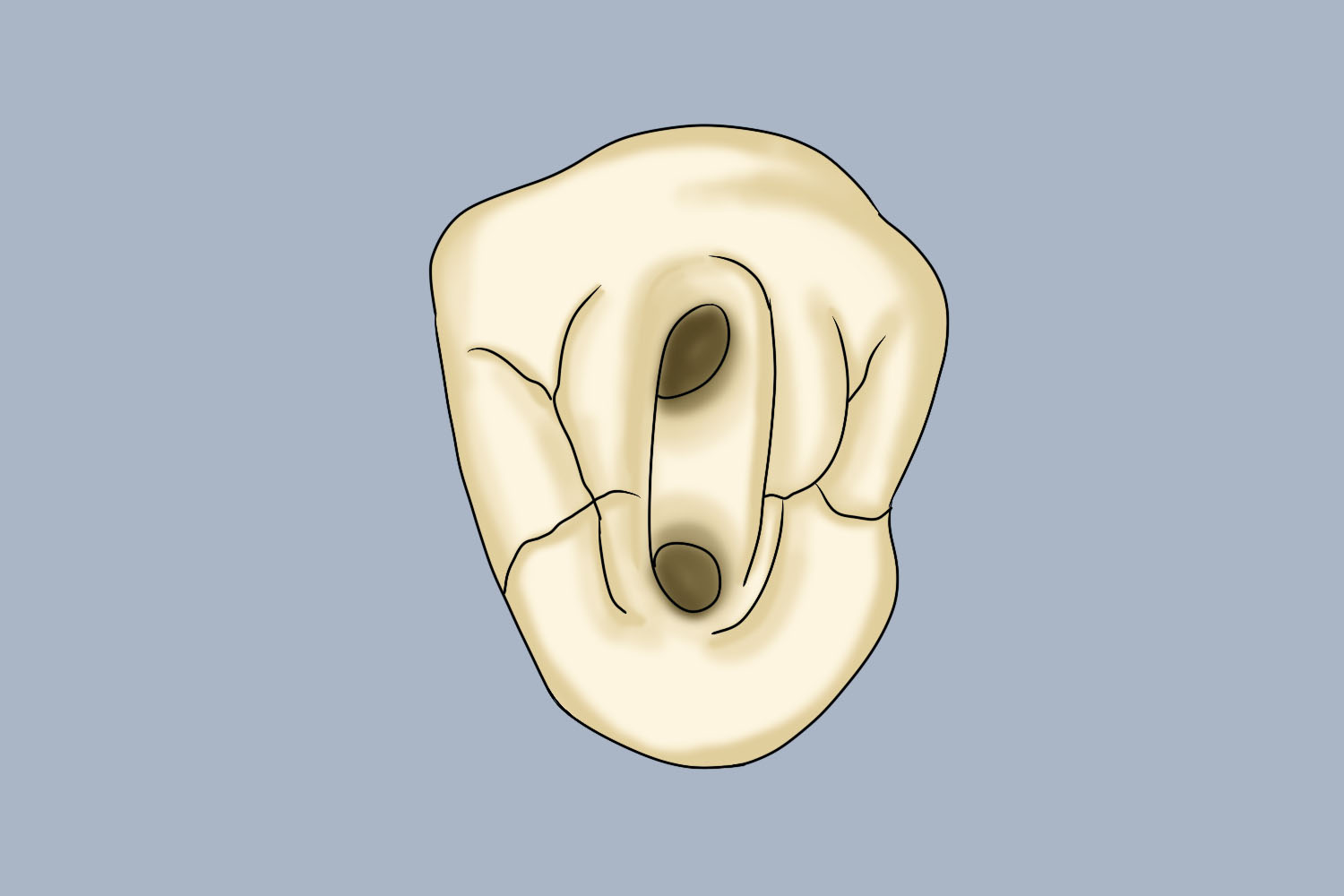 乳牙开髓洞形图片