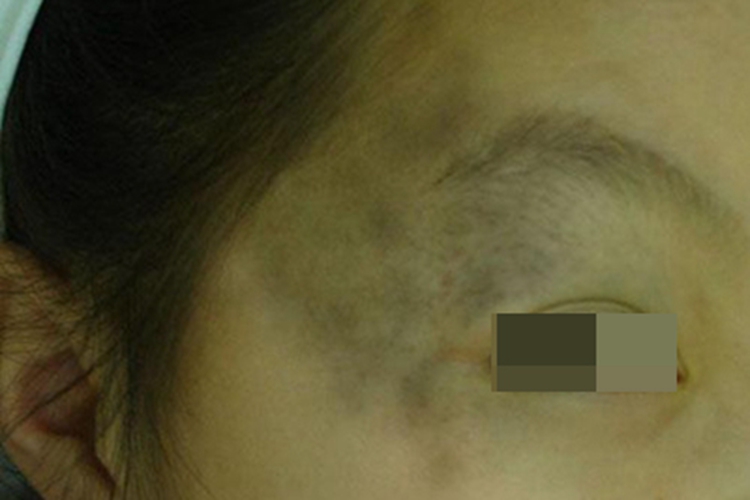 太田痣眼周有黑色斑片图