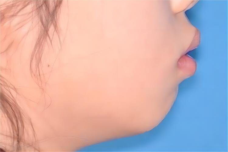 儿童严重双颌前突畸形图