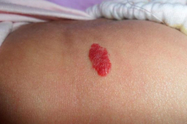 蔓状血管瘤肋部红斑图